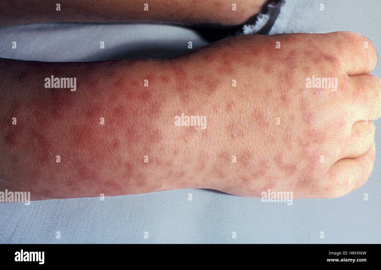 Rocky Mountain Spotted Fever Foto Stock