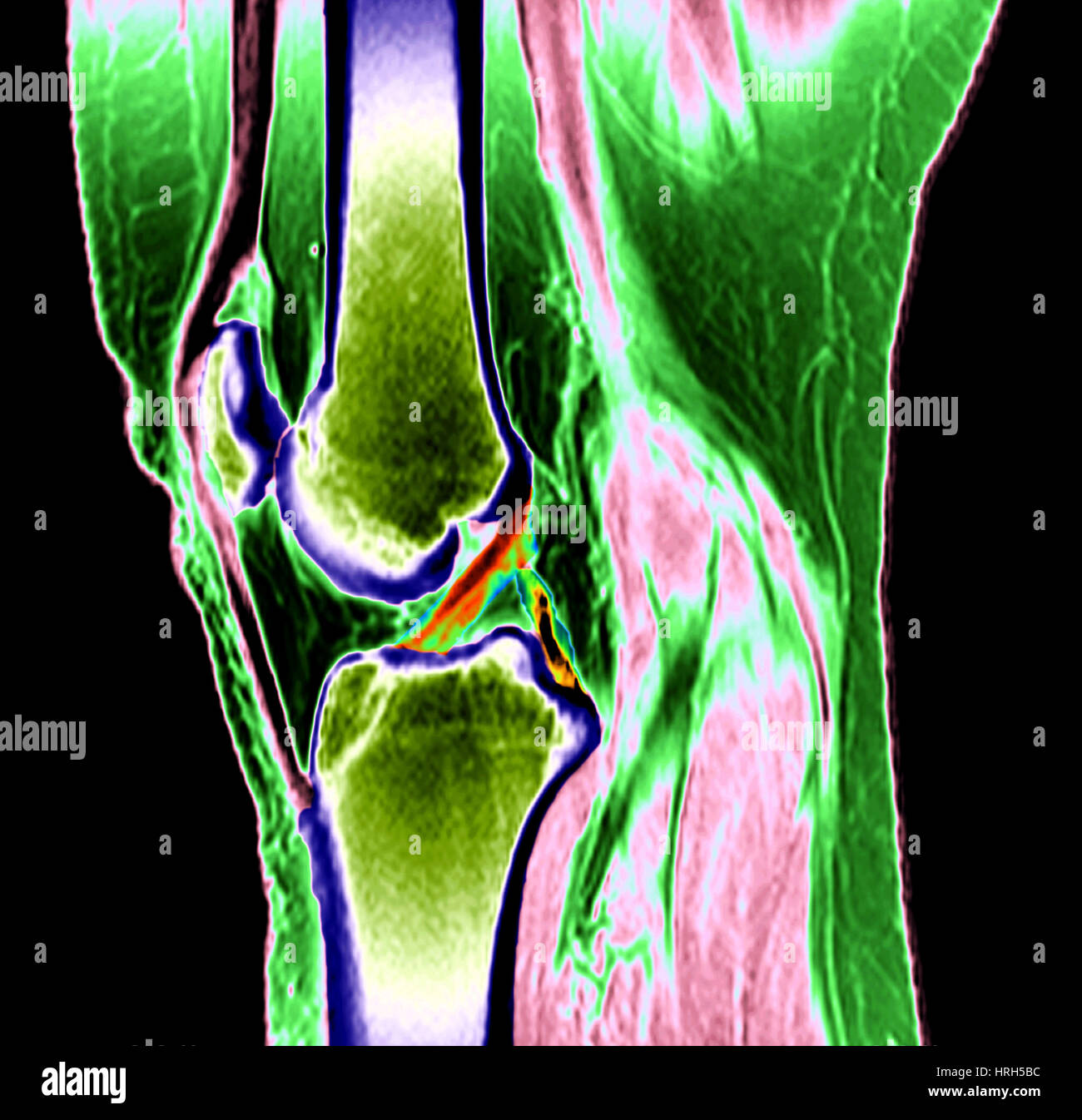 Ginocchio normale Foto Stock