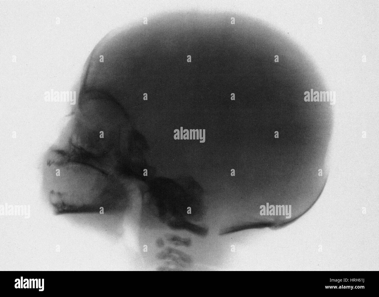 Cranio infantile x-ray Foto Stock