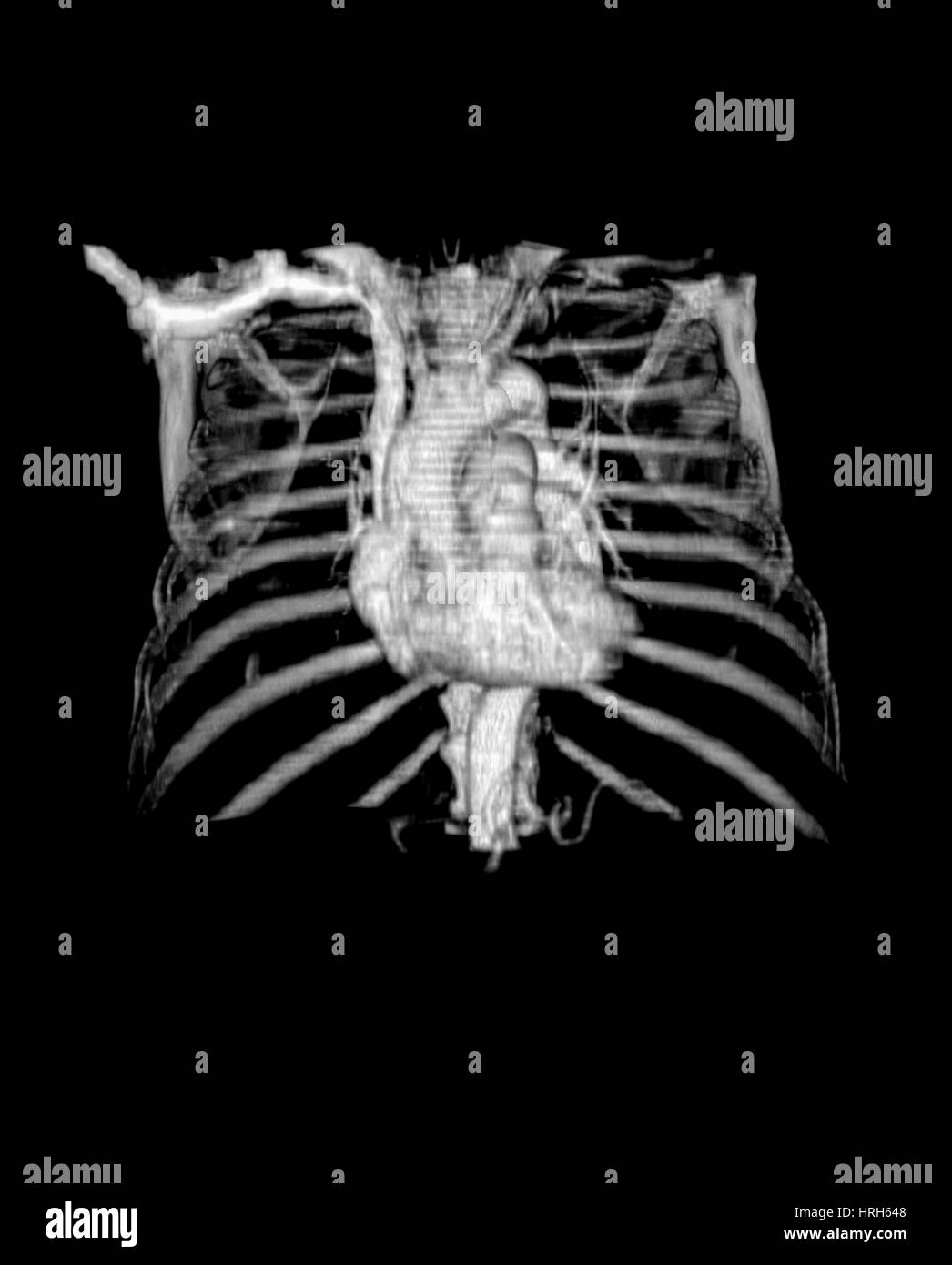 3D CTA del cuore e del torace Foto Stock