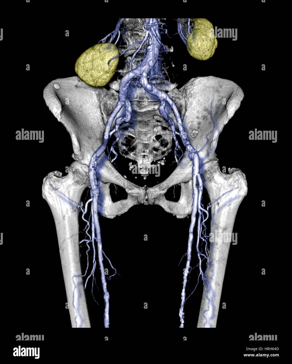 Il bacino e la parte superiore delle gambe con arteriosclerosi Foto Stock