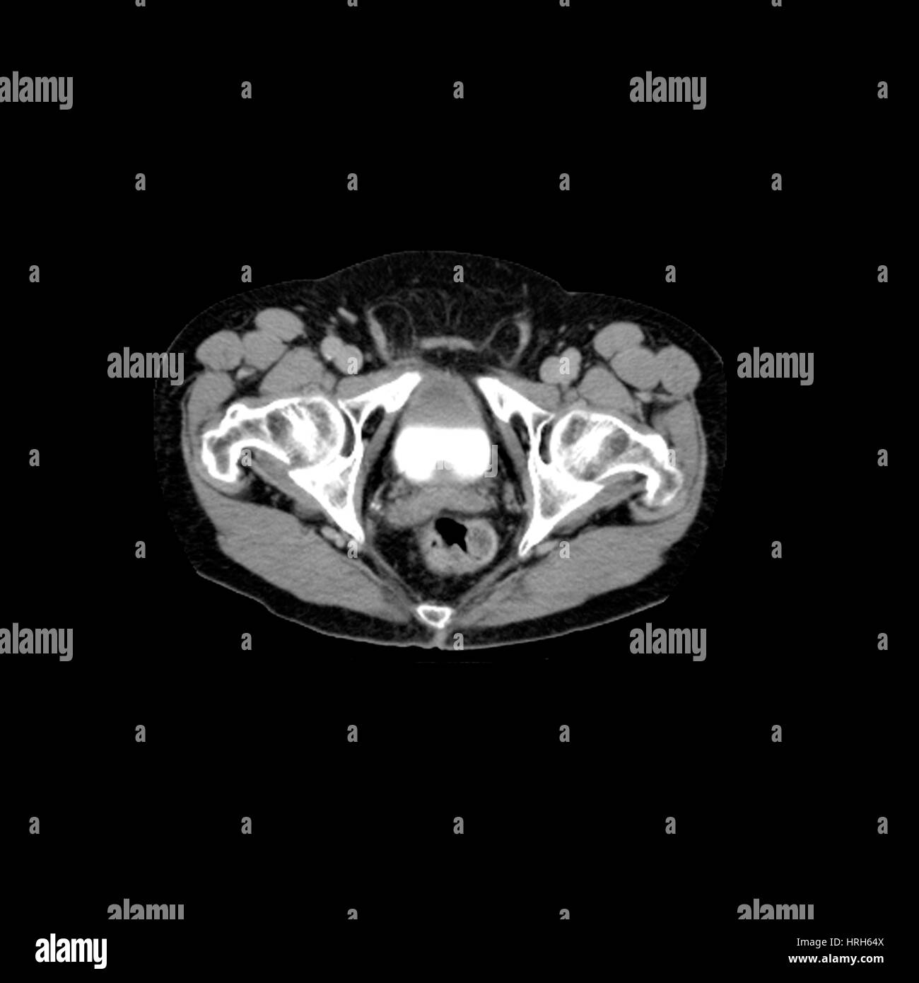 Ingrossamento della prostata Foto Stock