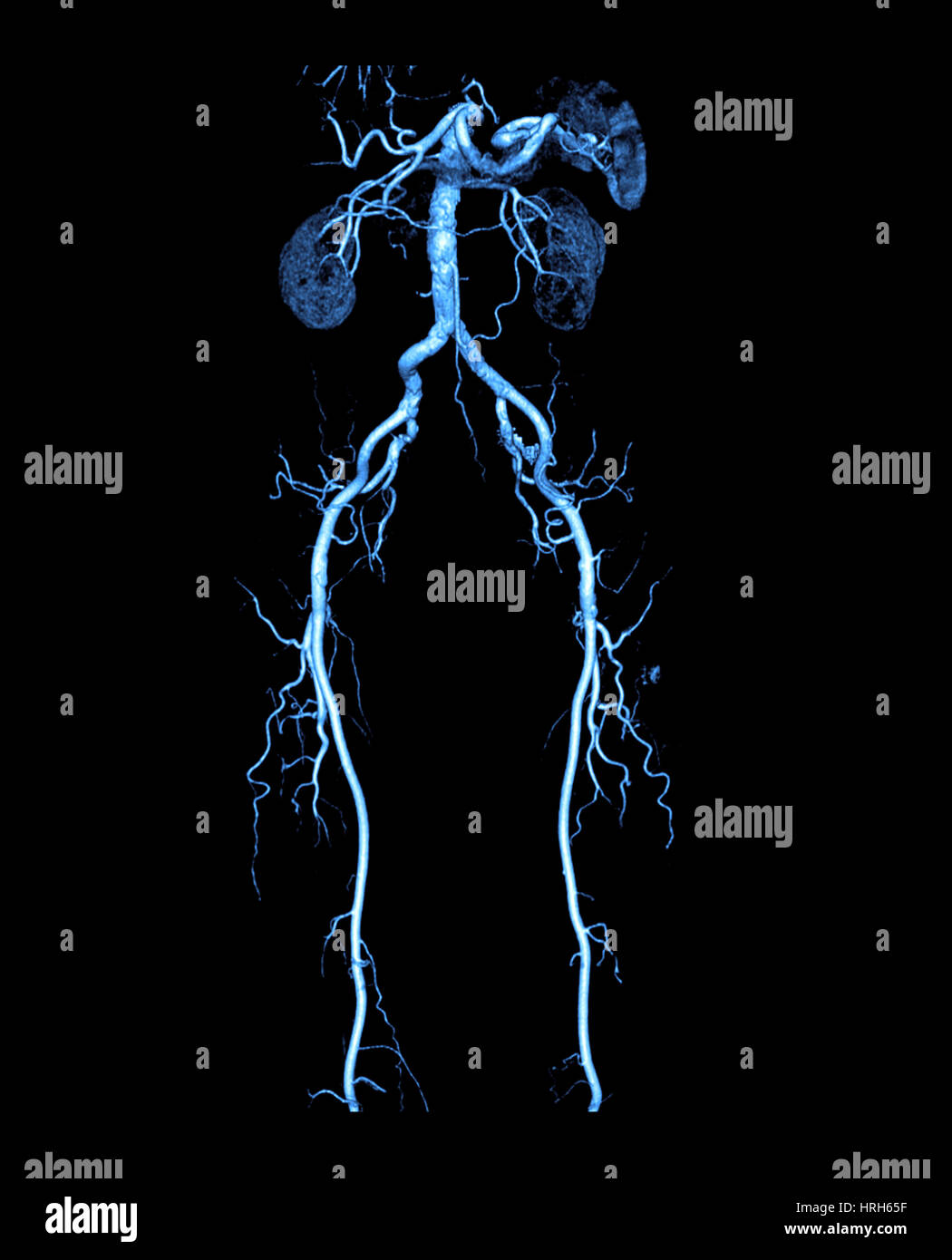 Angiogramma CT di addome e gambe Foto Stock