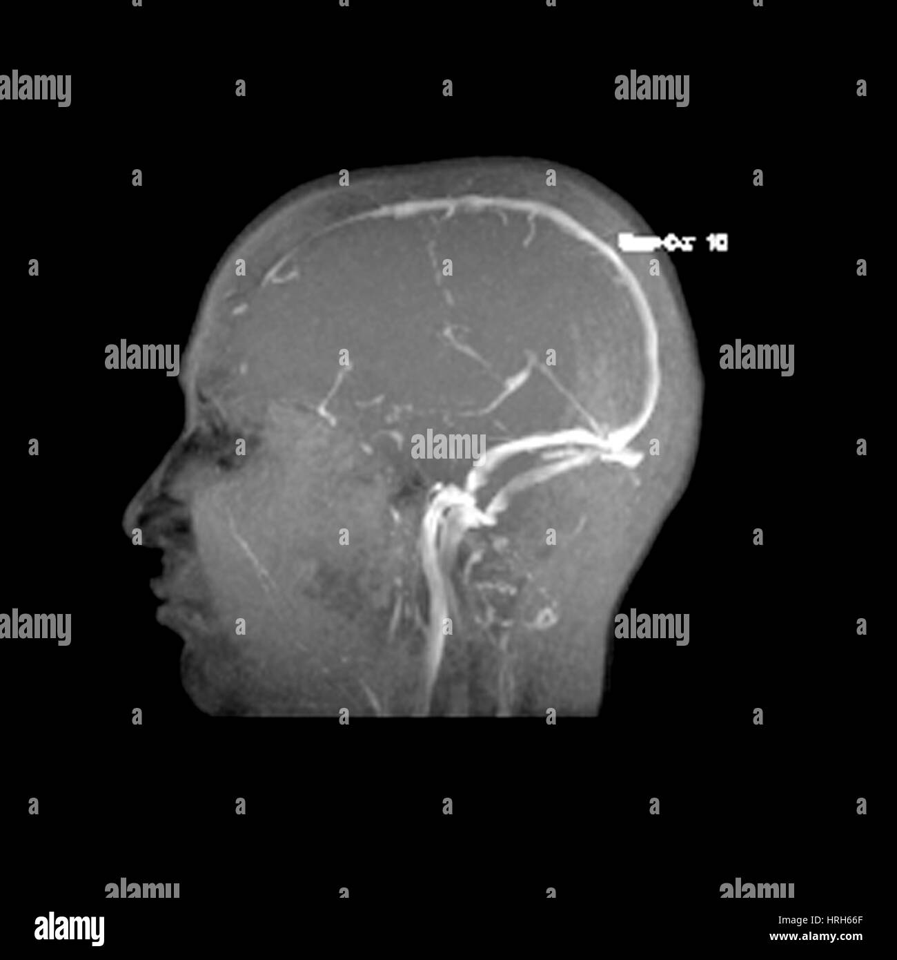 La normale anatomia venosa Foto Stock