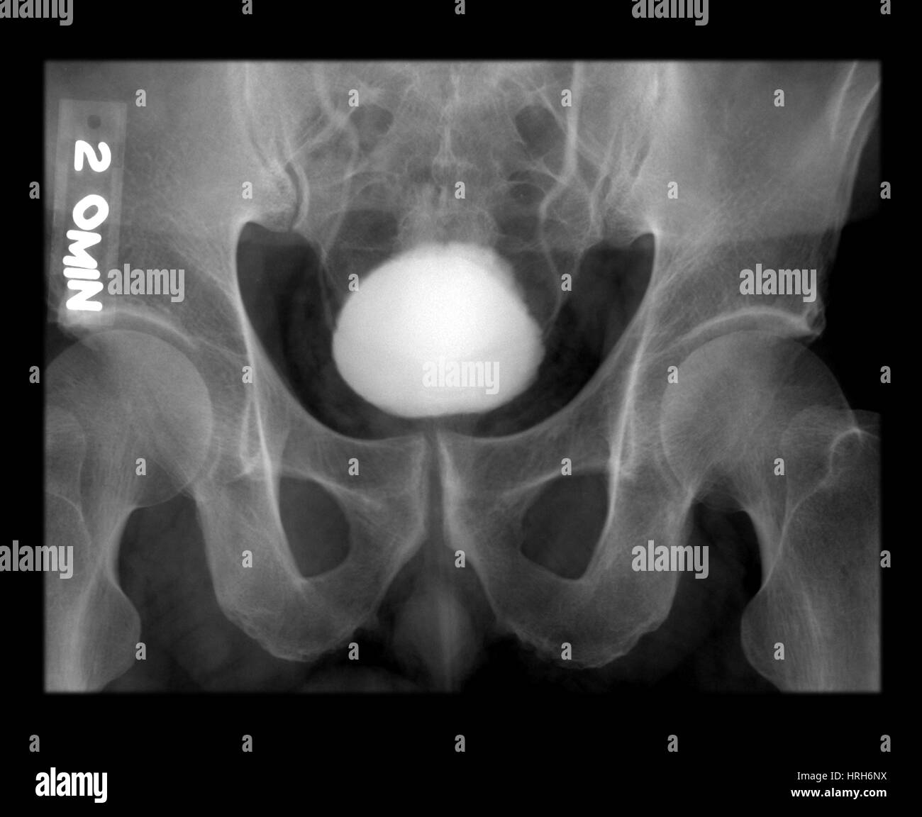 Raggi X normale della vescica urinaria Foto Stock