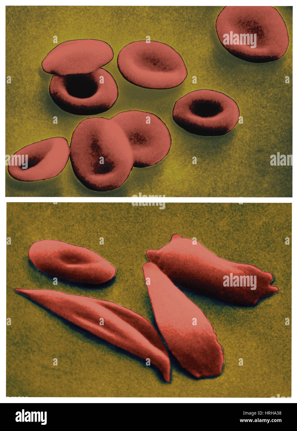 Il normale e la falce le cellule rosse del sangue Foto Stock