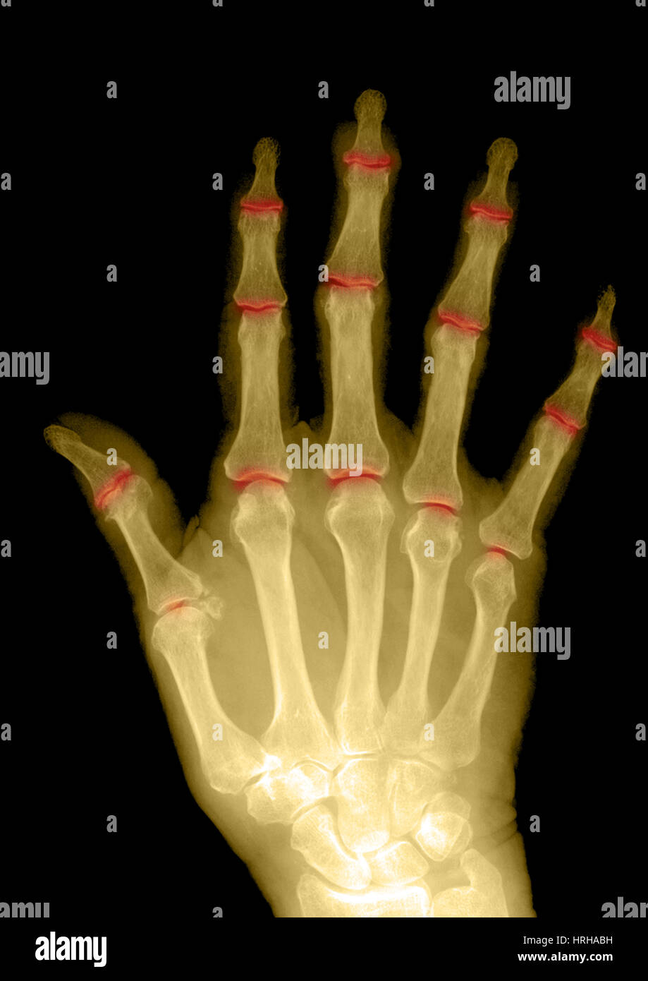 Osteoporosi e artrite degenerativa Foto Stock