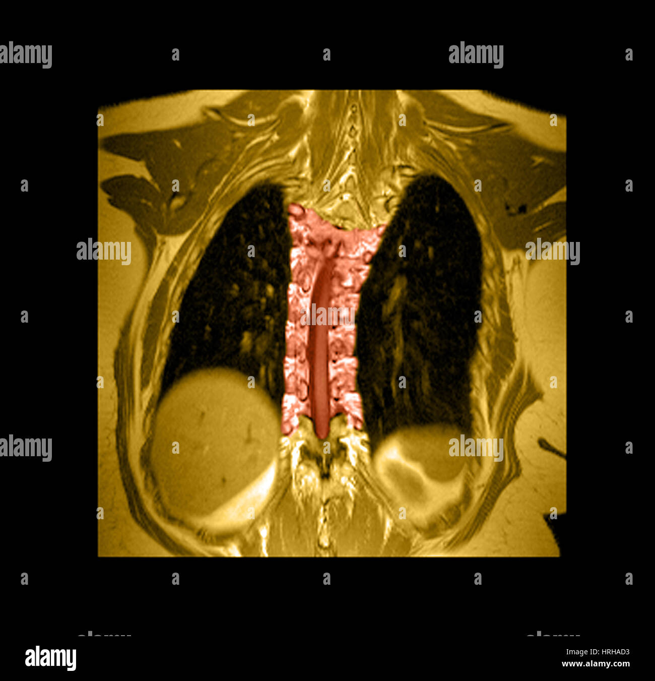 Mri di spina dorsale toracica immagini e fotografie stock ad alta
