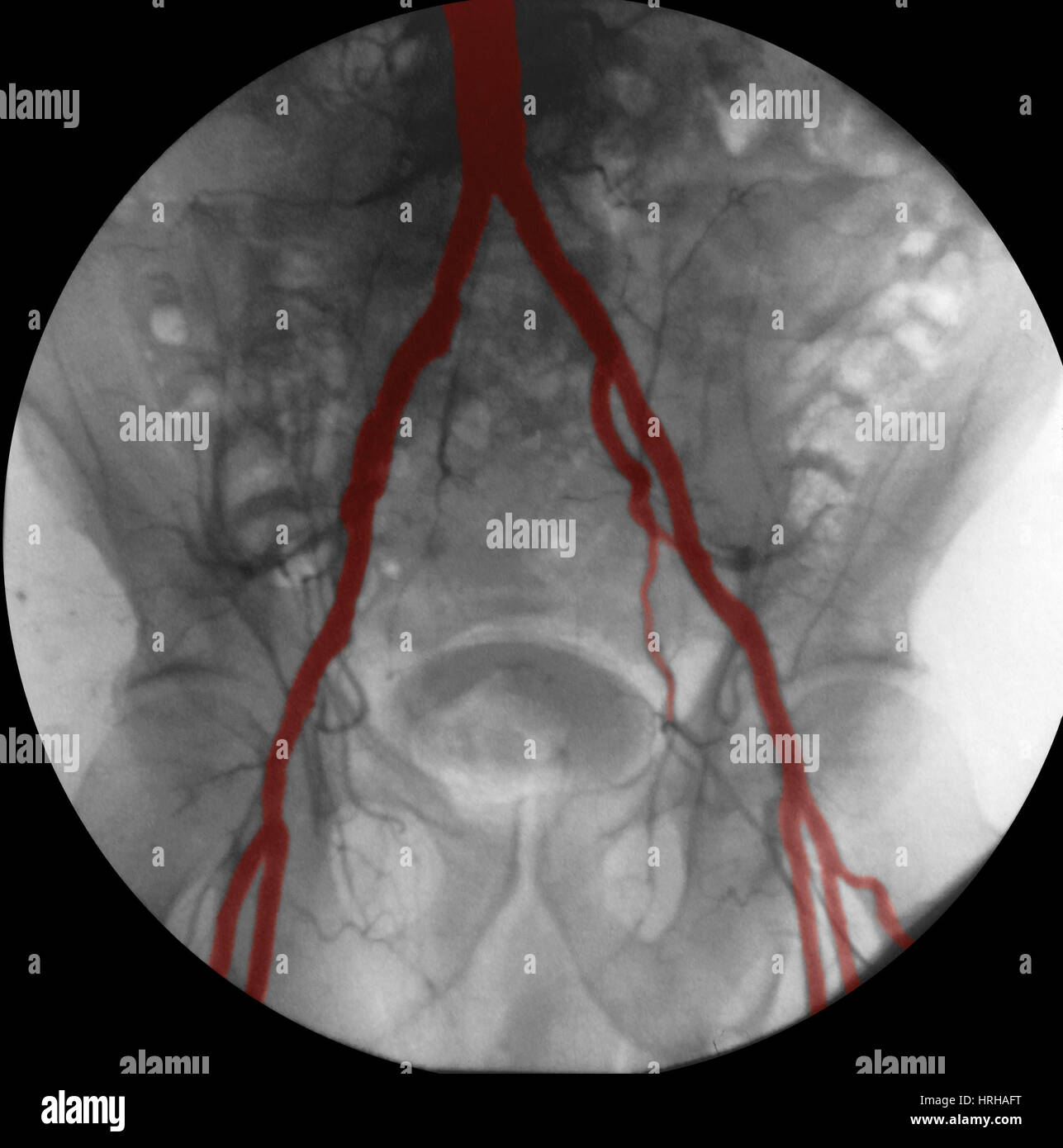 Angiogramma delle arterie iliache Foto Stock