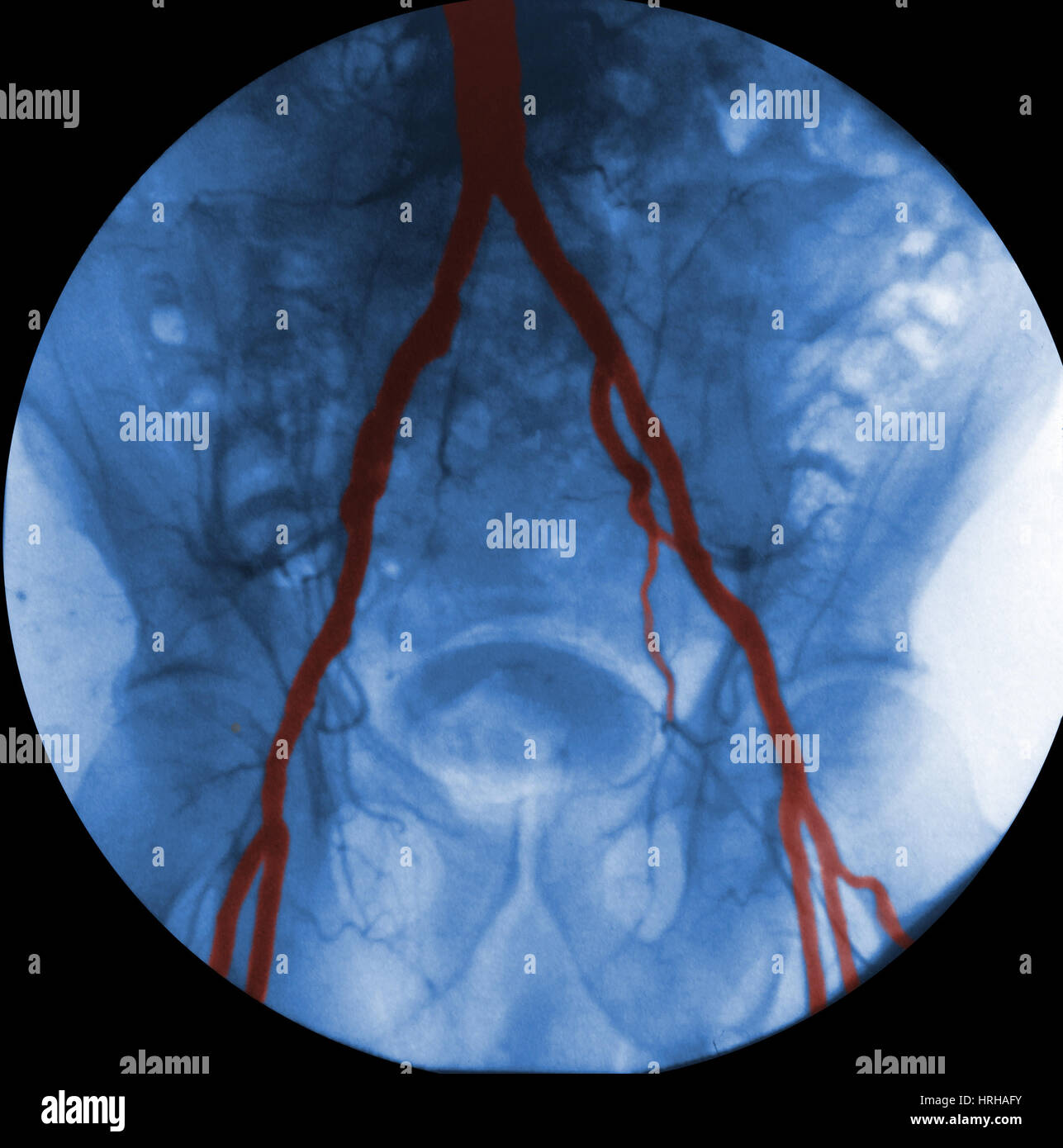 Angiogramma delle arterie iliache Foto Stock