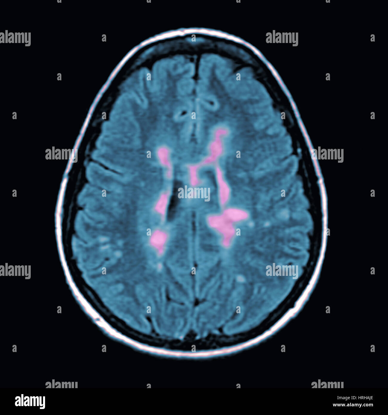 MRI della sclerosi multipla Foto Stock