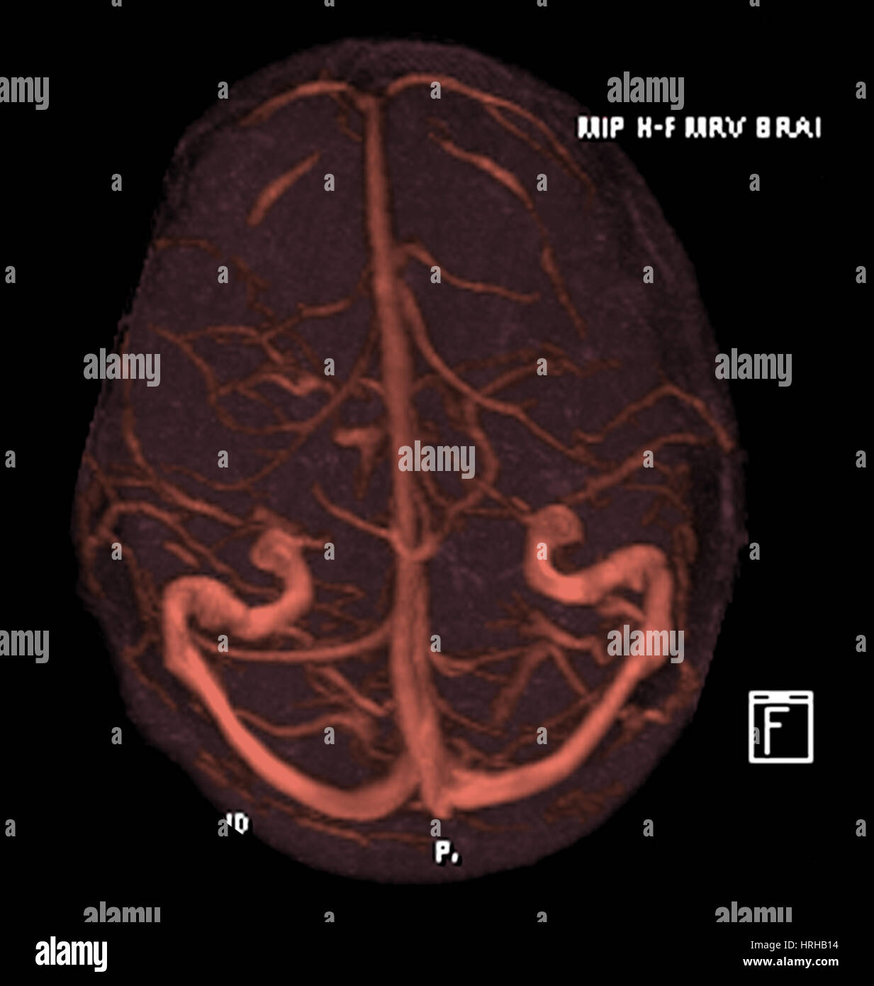 Intracranica Risonanza Magnetica Venogram Foto Stock