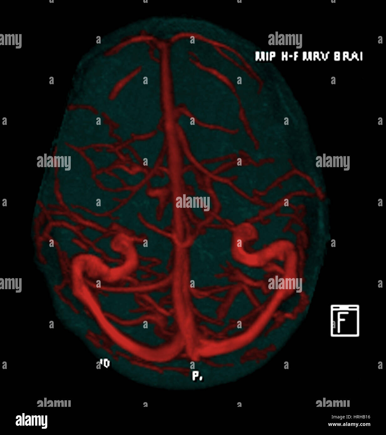Intracranica Risonanza Magnetica Venogram Foto Stock