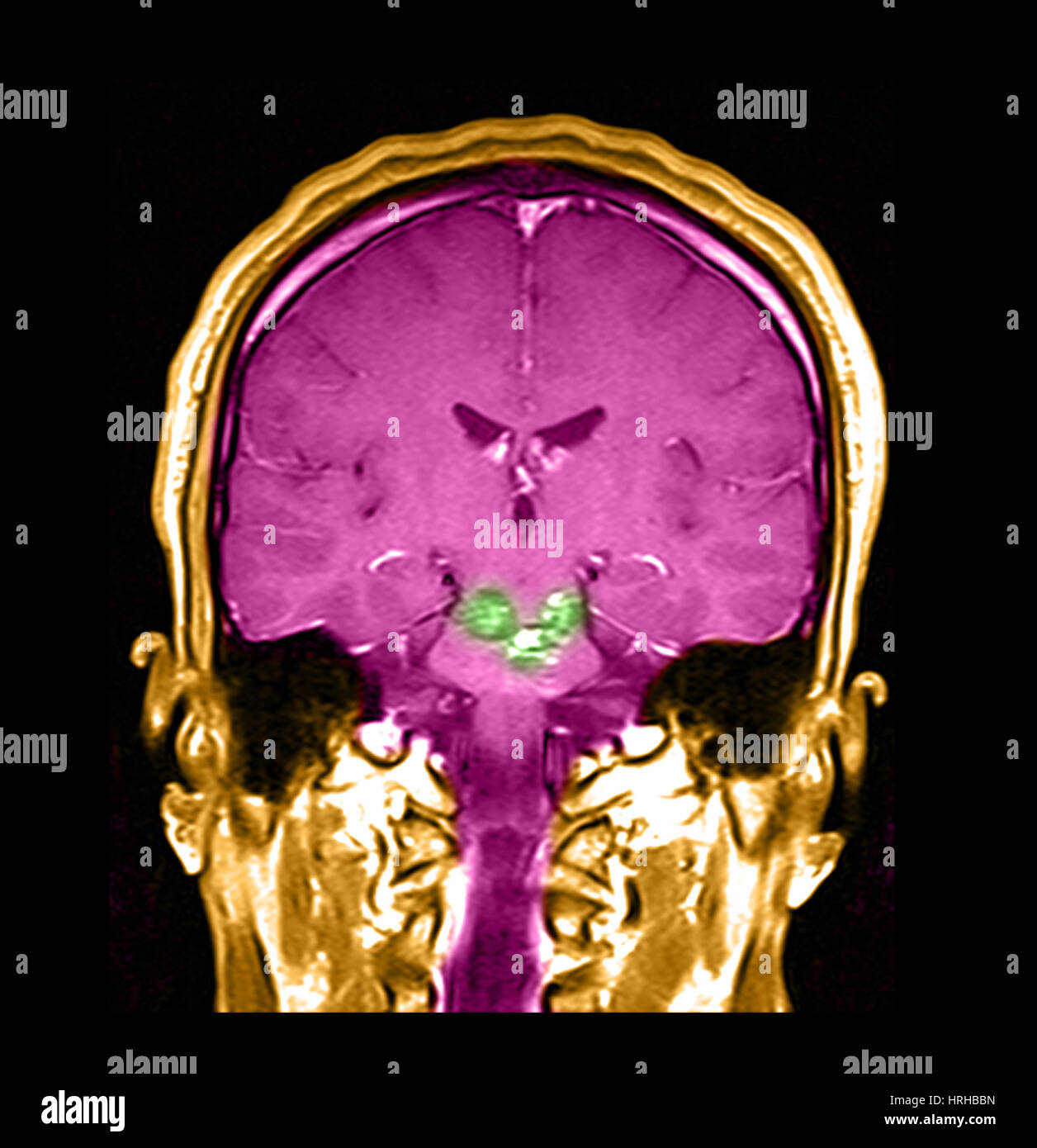 MRI del tronco cerebrale malformazioni cavernoso Foto Stock