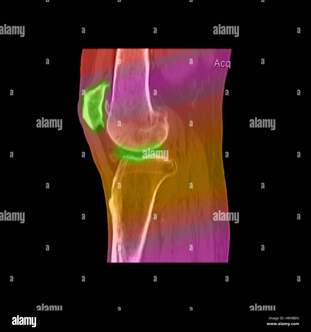 Ginocchio che mostra l'osteoporosi Foto Stock