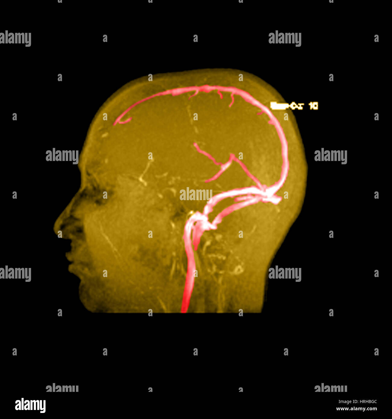 La normale anatomia venosa Foto Stock