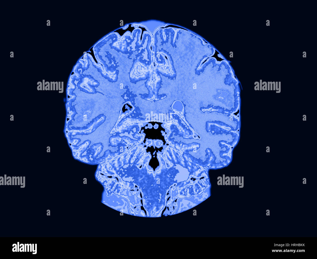 Vista coronale MRI del cervello normale Foto Stock