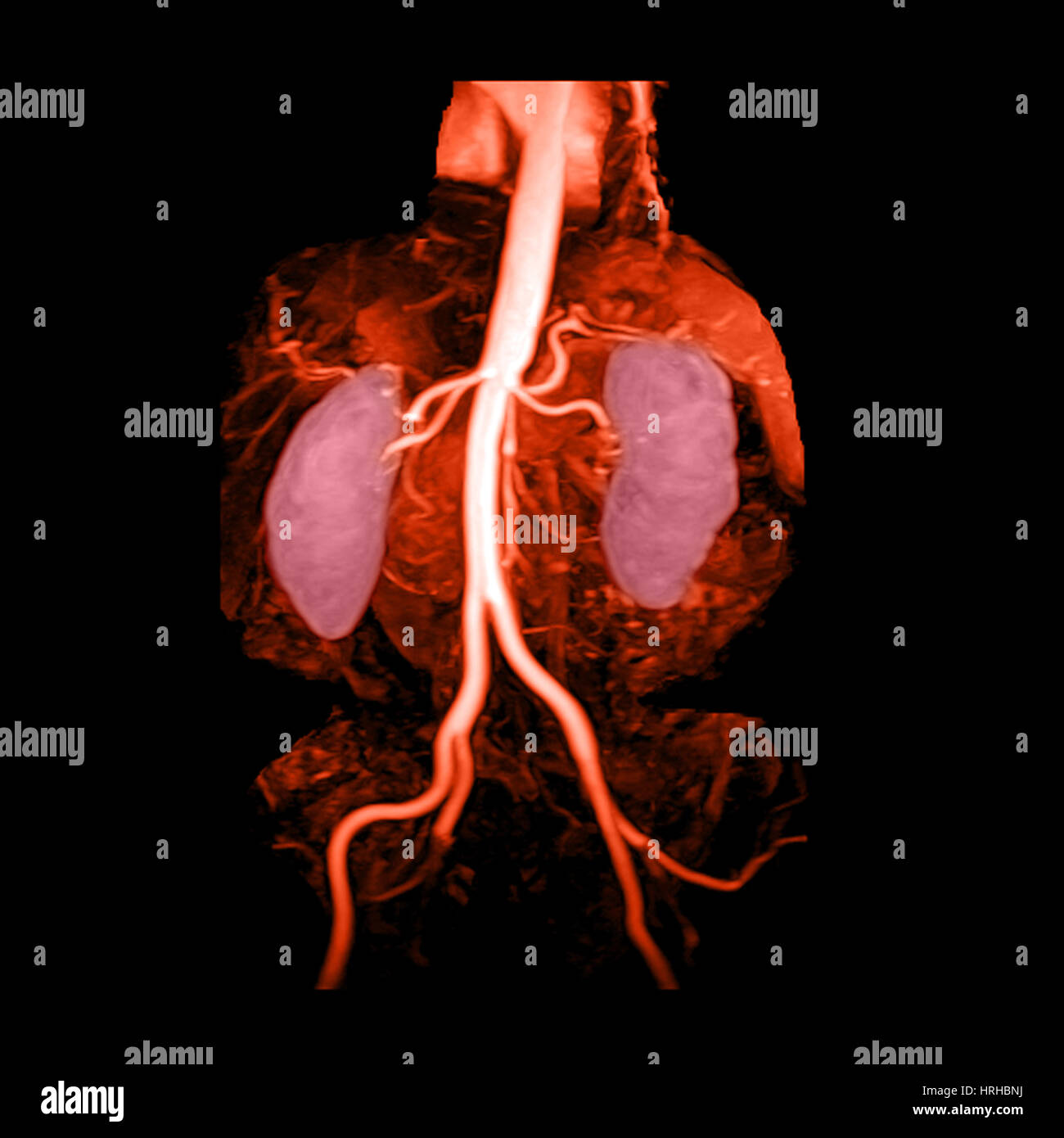 Aorta addominale, i reni e le arterie iliache Foto Stock