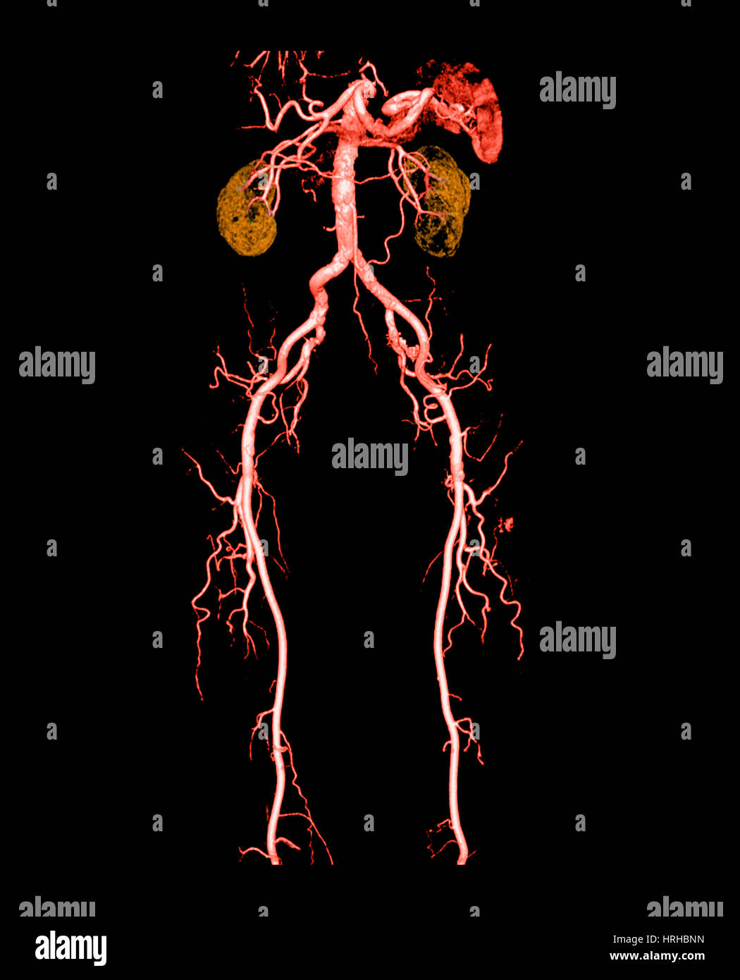 Angiogramma CT di addome e gambe Foto Stock