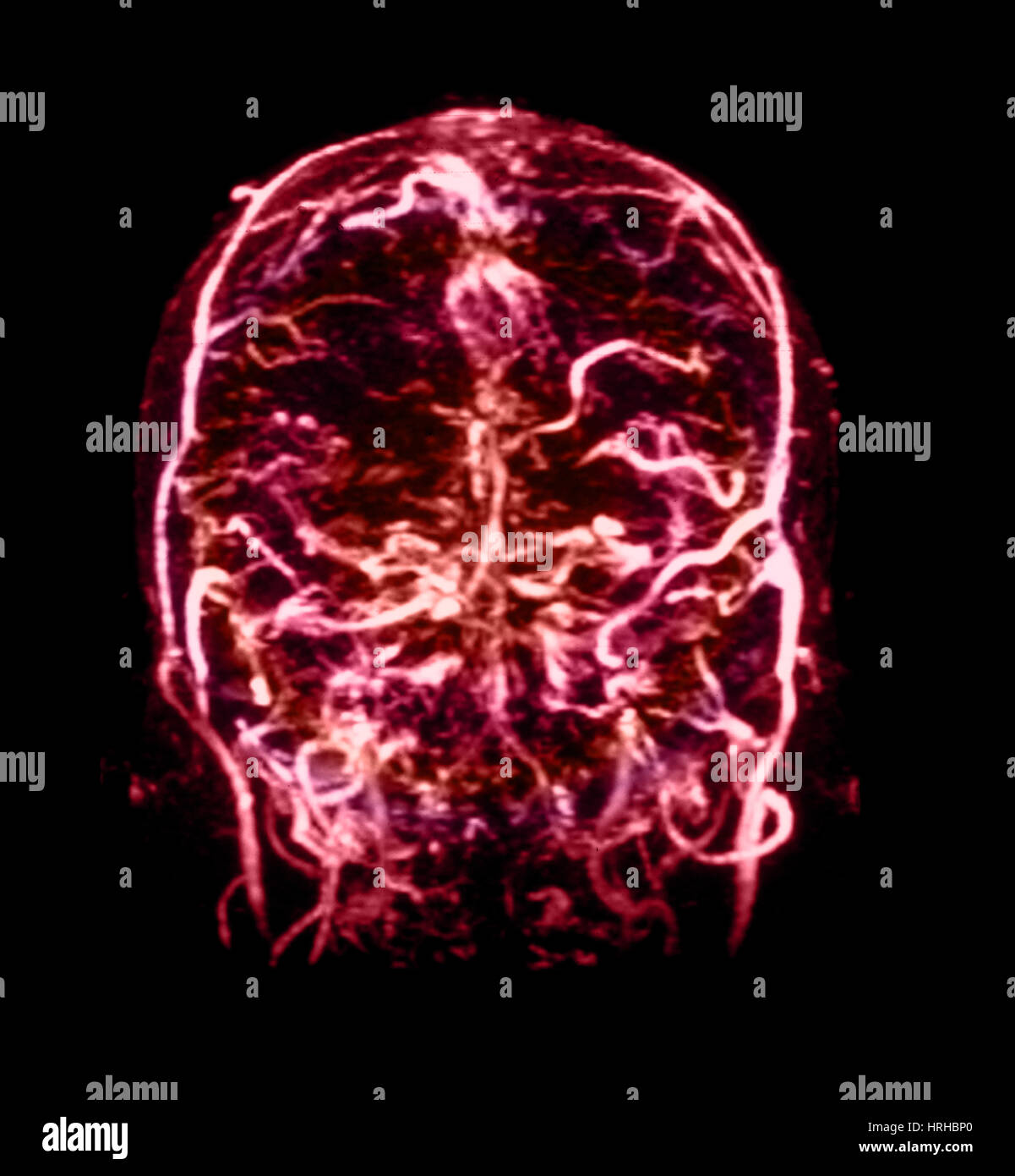MRI di Venogram durale di trombosi sinusale Foto Stock
