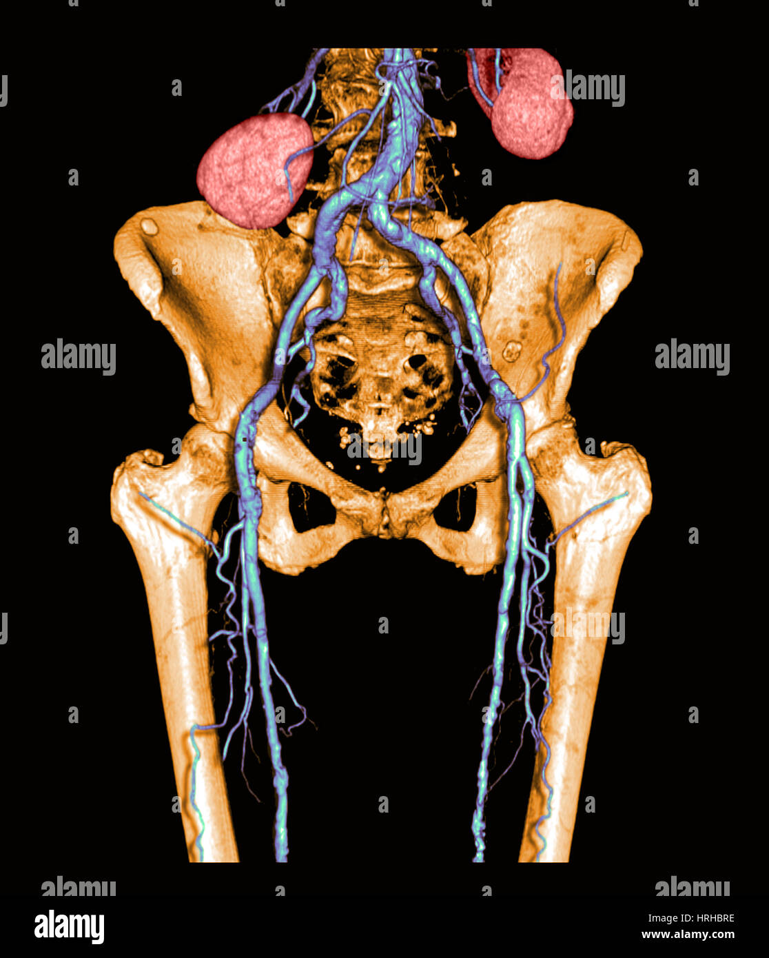 Il bacino e la parte superiore delle gambe con arteriosclerosi Foto Stock