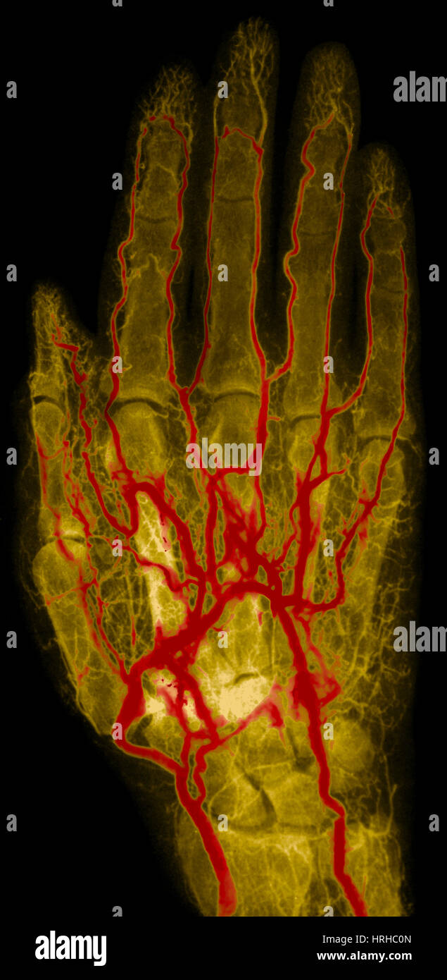 Mano Arteriogram Foto Stock