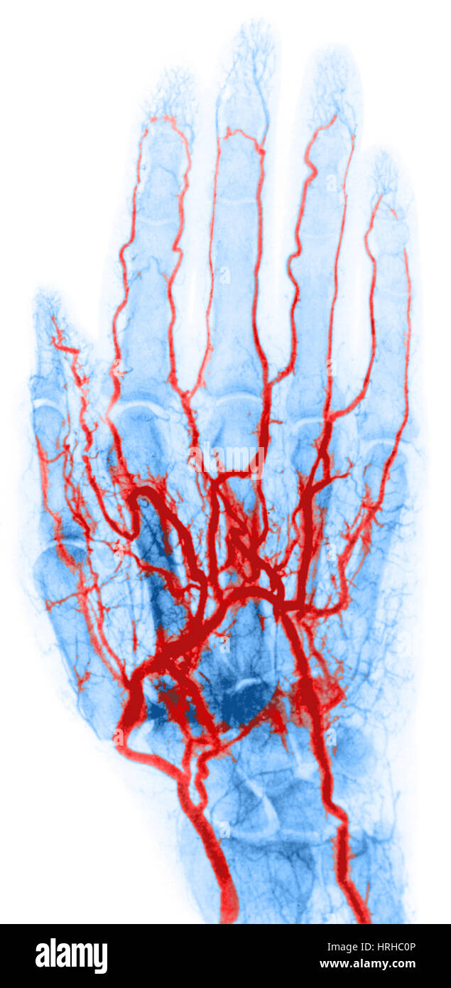 Mano Arteriogram Foto Stock