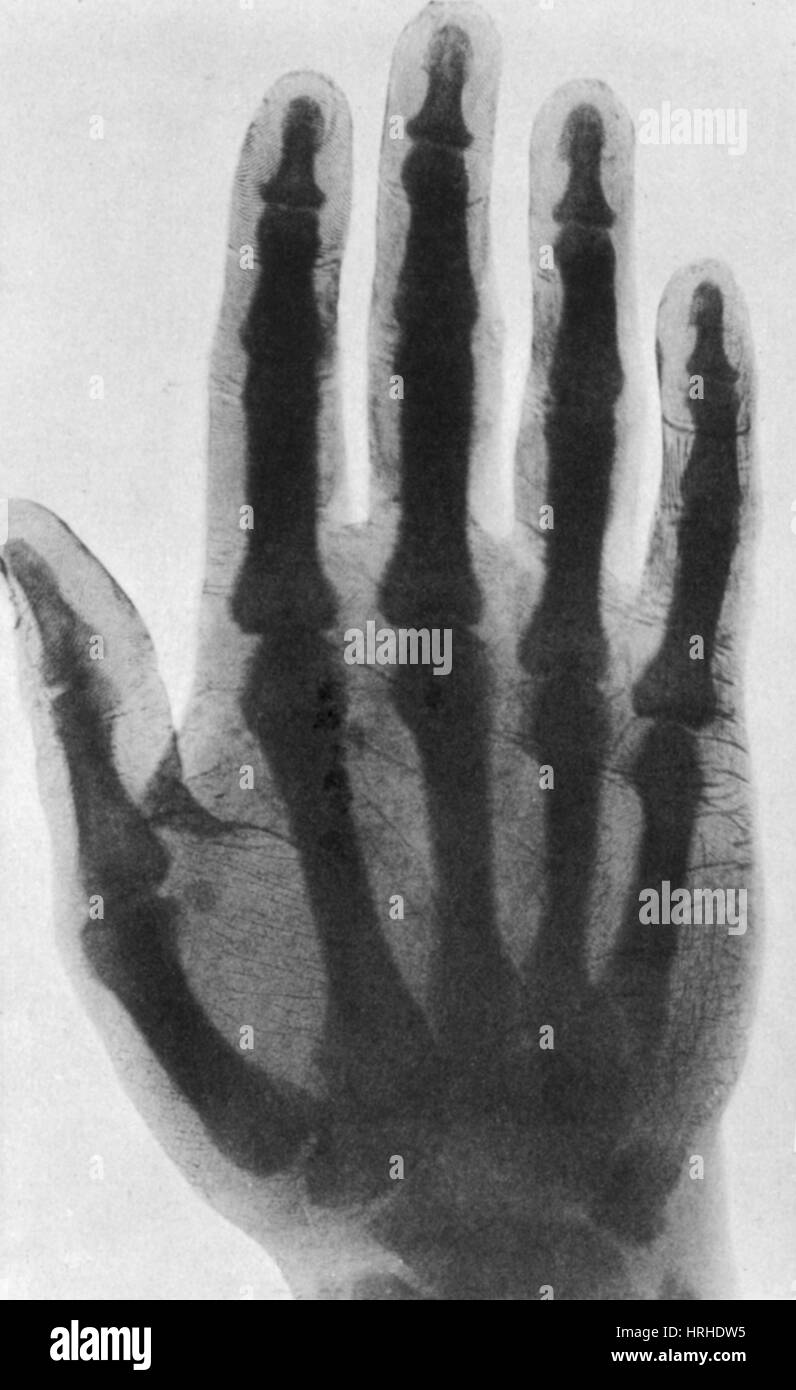 Inizio X-ray, 1897 Foto Stock