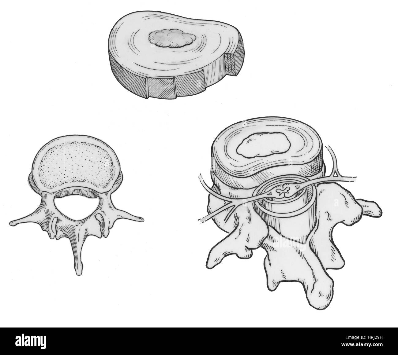 Illustrazione dei dischi spinali Foto Stock