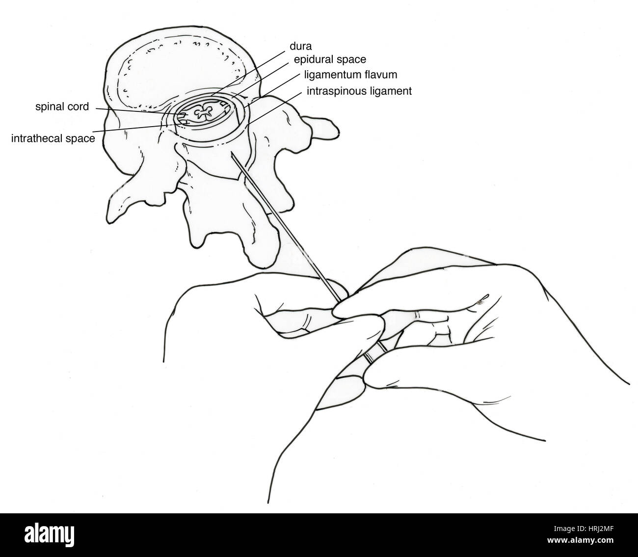 Illustrazione della puntura lombare (Spinal Tap) Foto Stock