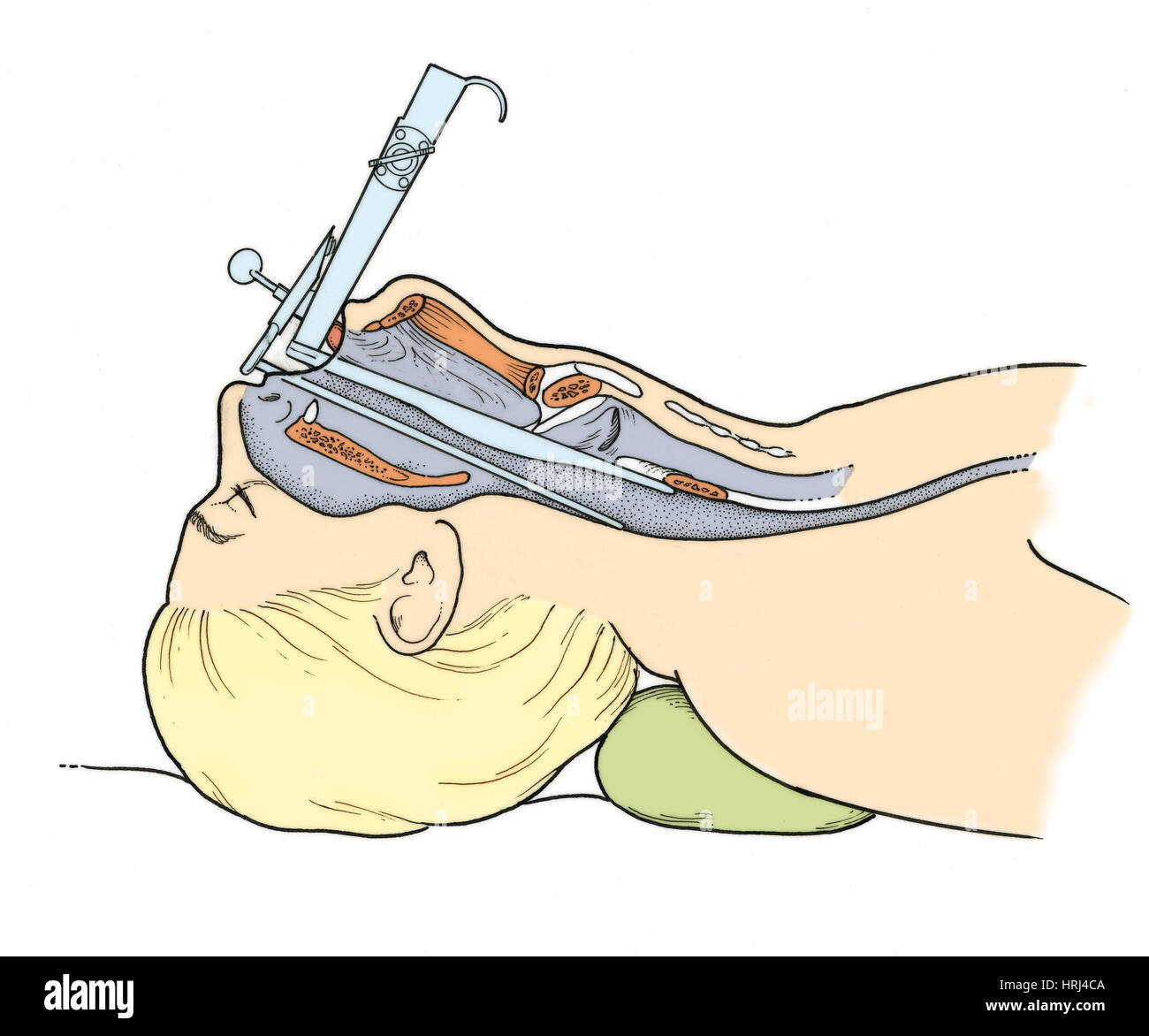Illustrazione di Laryngoscopy Foto Stock