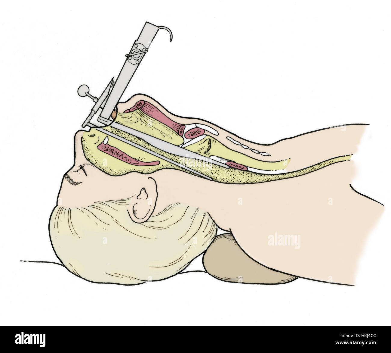 Illustrazione di Laryngoscopy Foto Stock