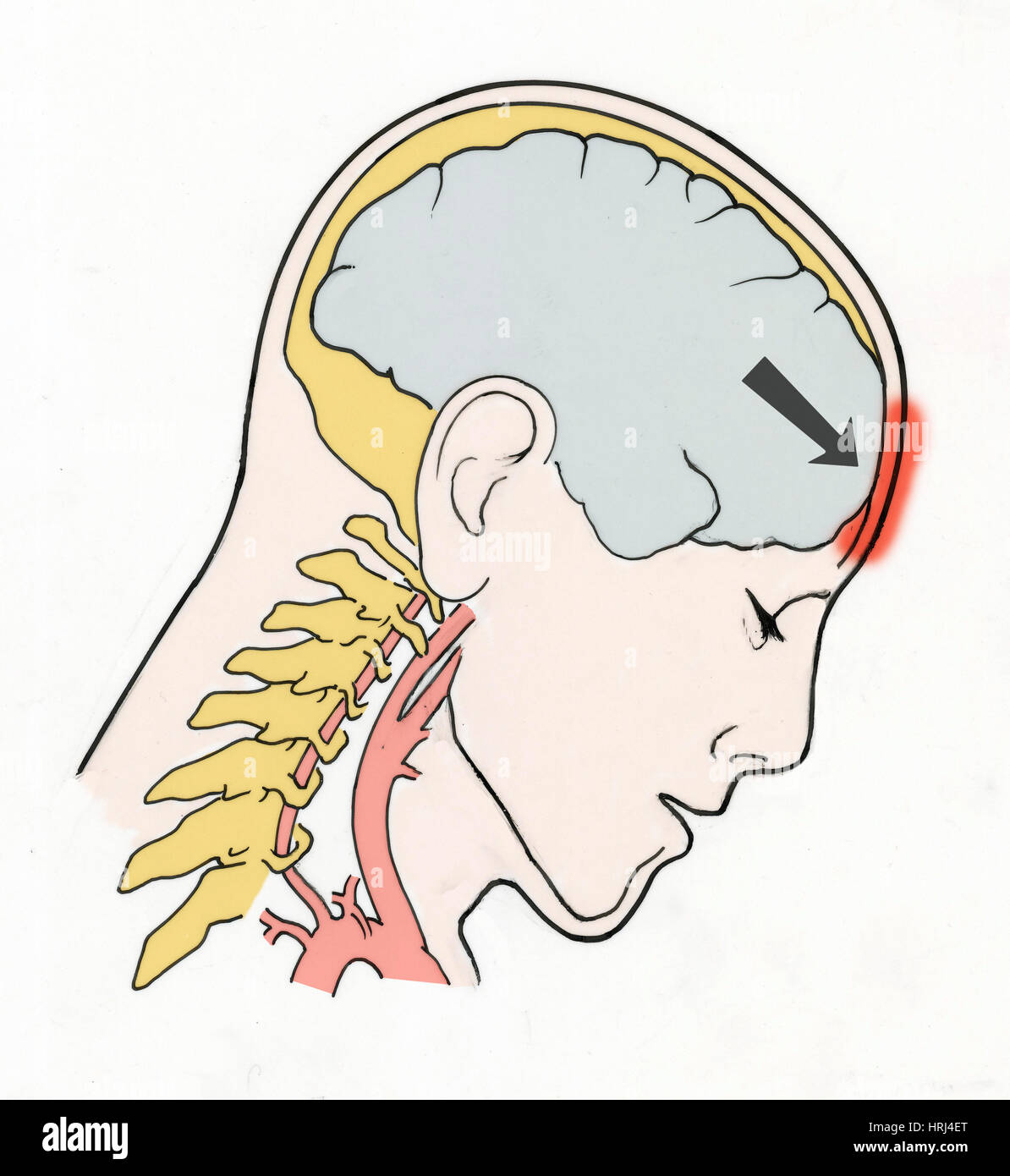 Illustrazione del colpo di frusta Foto Stock