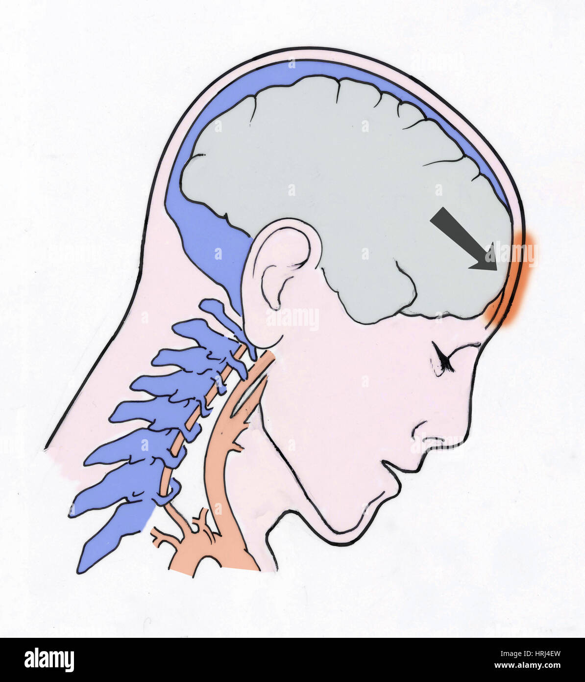 Illustrazione del colpo di frusta Foto Stock
