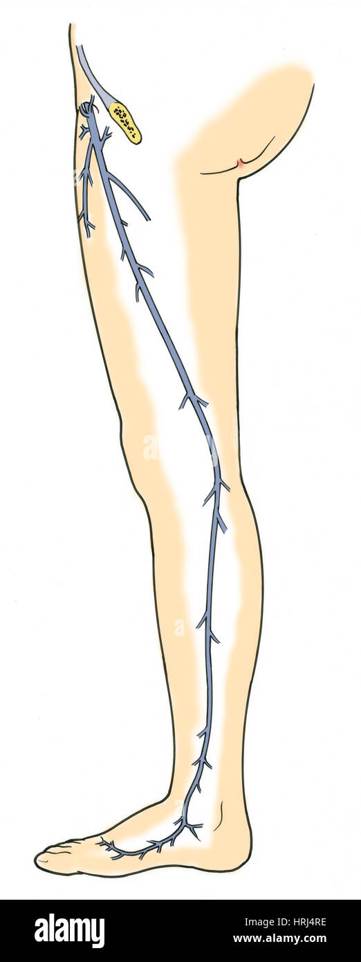 Grande vena safena immagini e fotografie stock ad alta risoluzione - Alamy