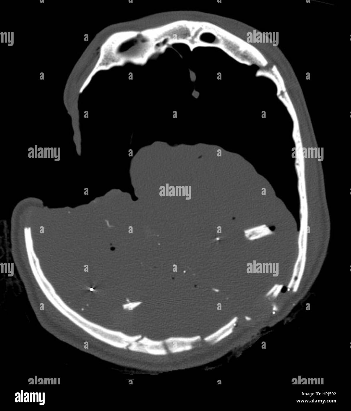 La parte tac, ferita gunshot Foto Stock
