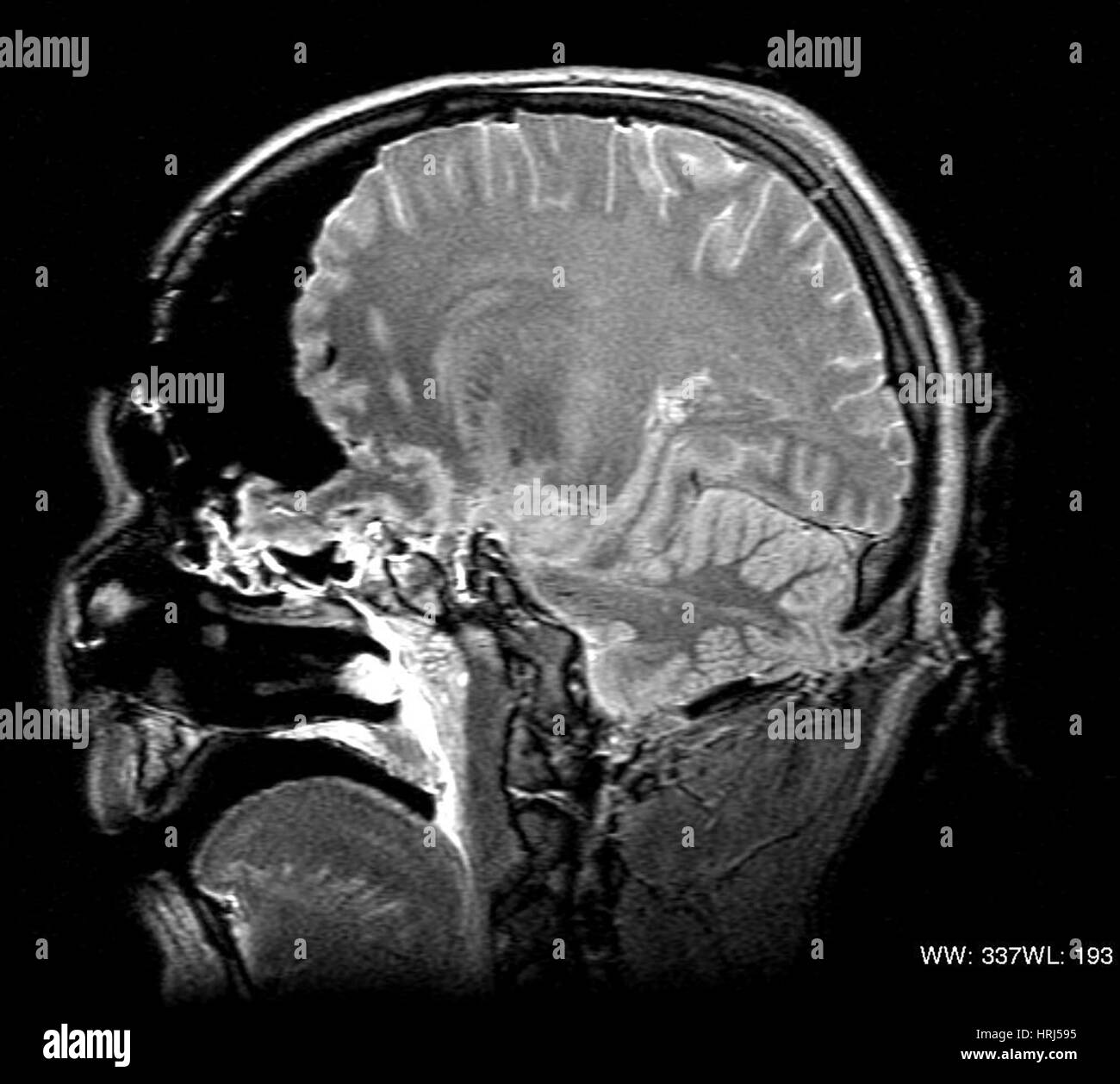 MRI sezione trasversale, avvolto via Foto Stock