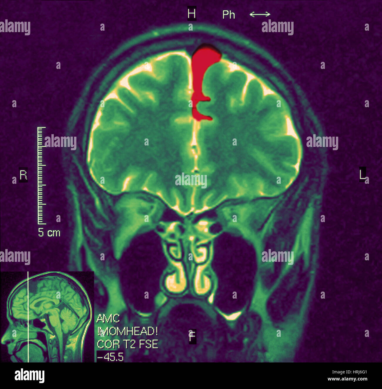 MRI MOSTRA Arachnoid cisti Foto Stock