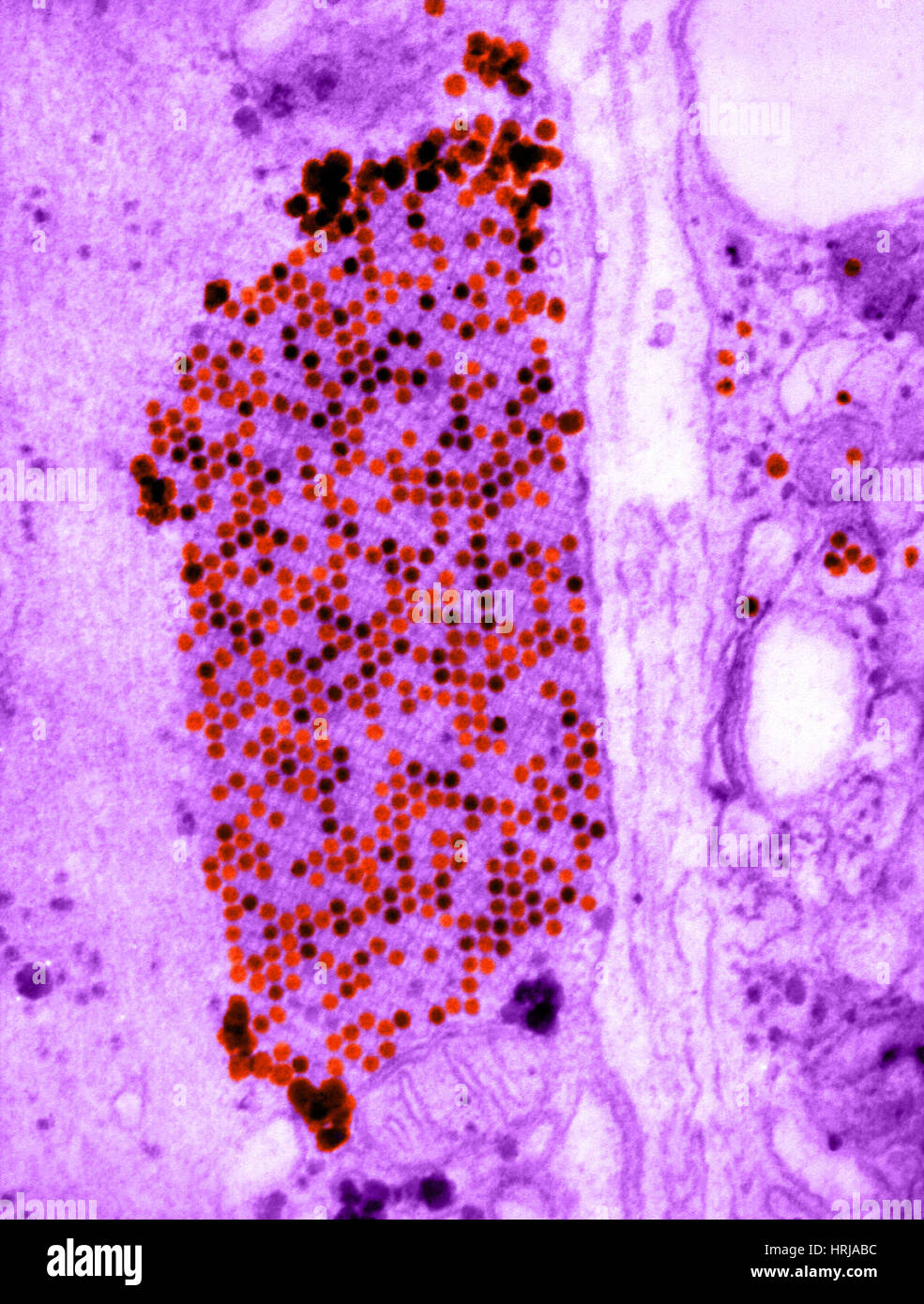 Coxsackie B3 Virus, TEM Foto Stock