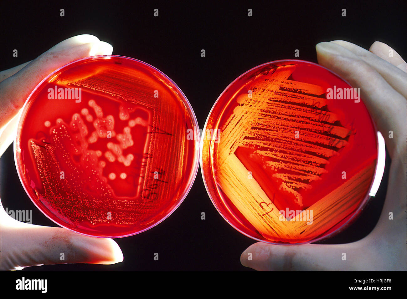 Staphyloccus e infezioni da Streptococcus Foto Stock