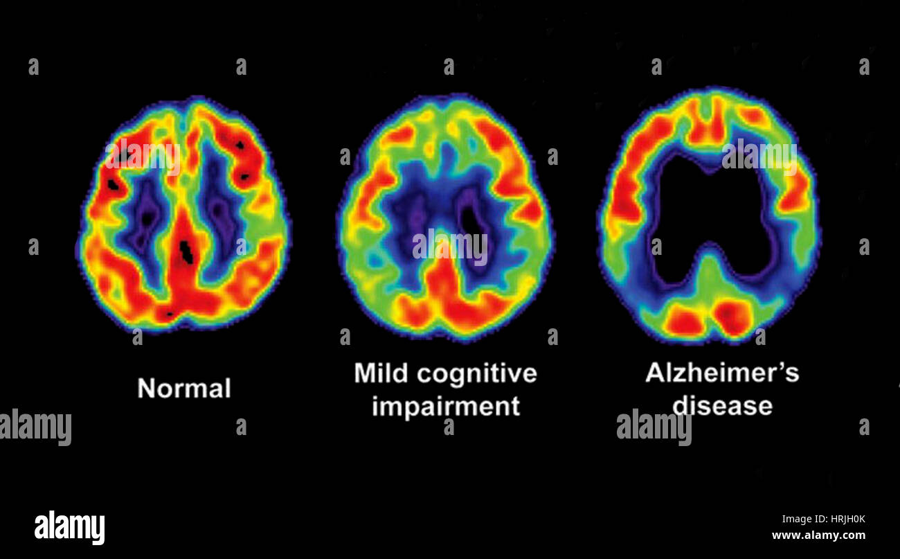 Normale, compromessa e il morbo di Alzheimer cervello scansioni PET Foto Stock