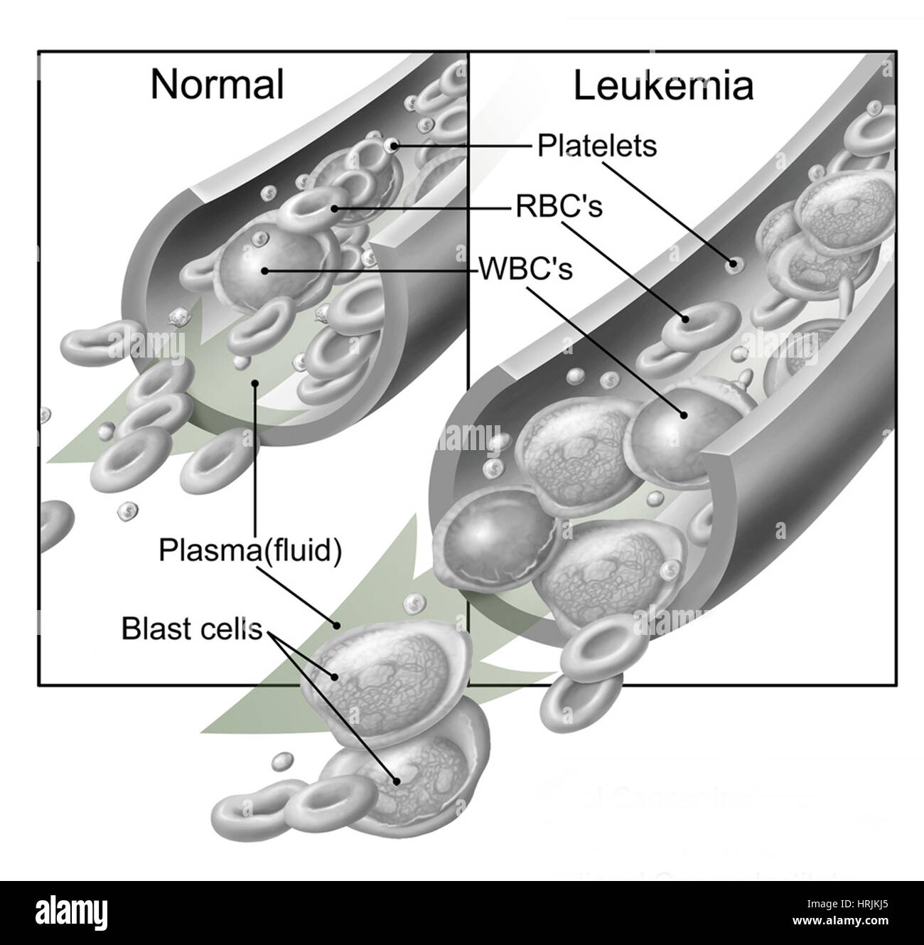 Cellule ematiche normali e leucemia Foto Stock