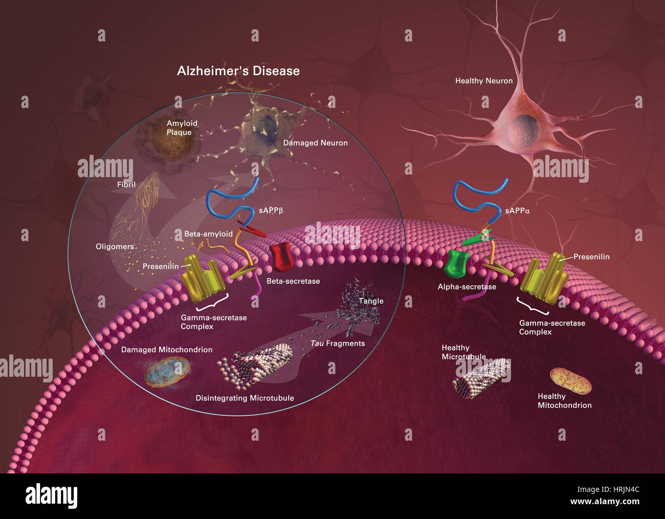 Il morbo di Alzheimer Foto Stock