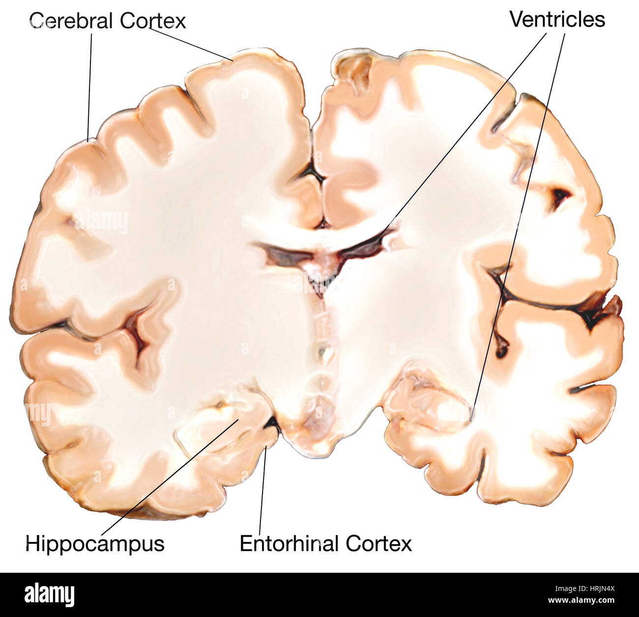 Il morbo di Alzheimer, PRECLINICI Foto Stock