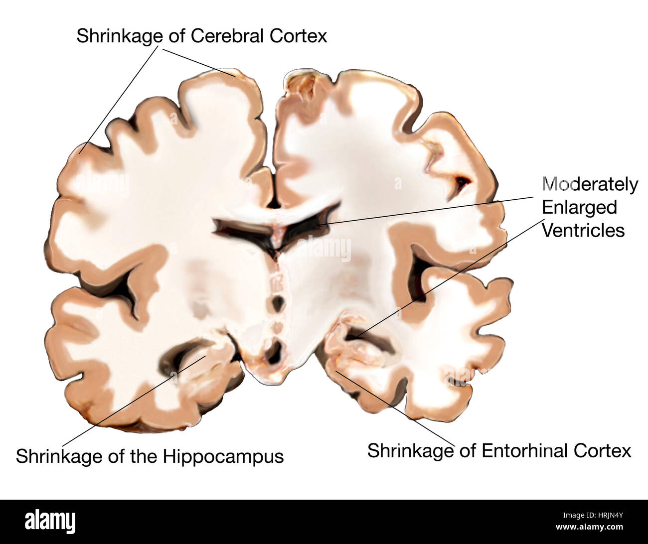 Il morbo di Alzheimer, di entità da lieve a moderata Foto Stock