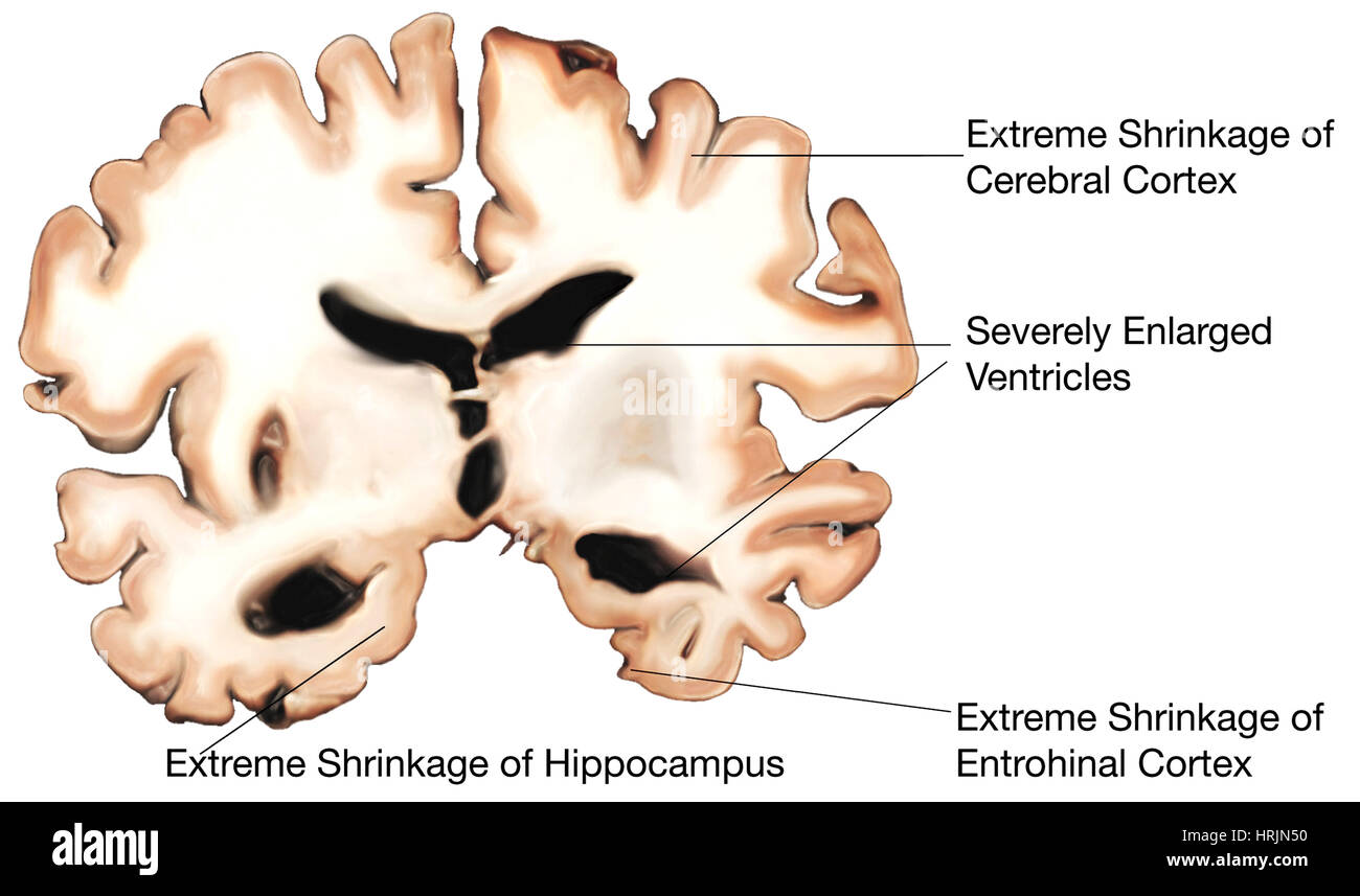 Il morbo di Alzheimer, gravi Foto Stock
