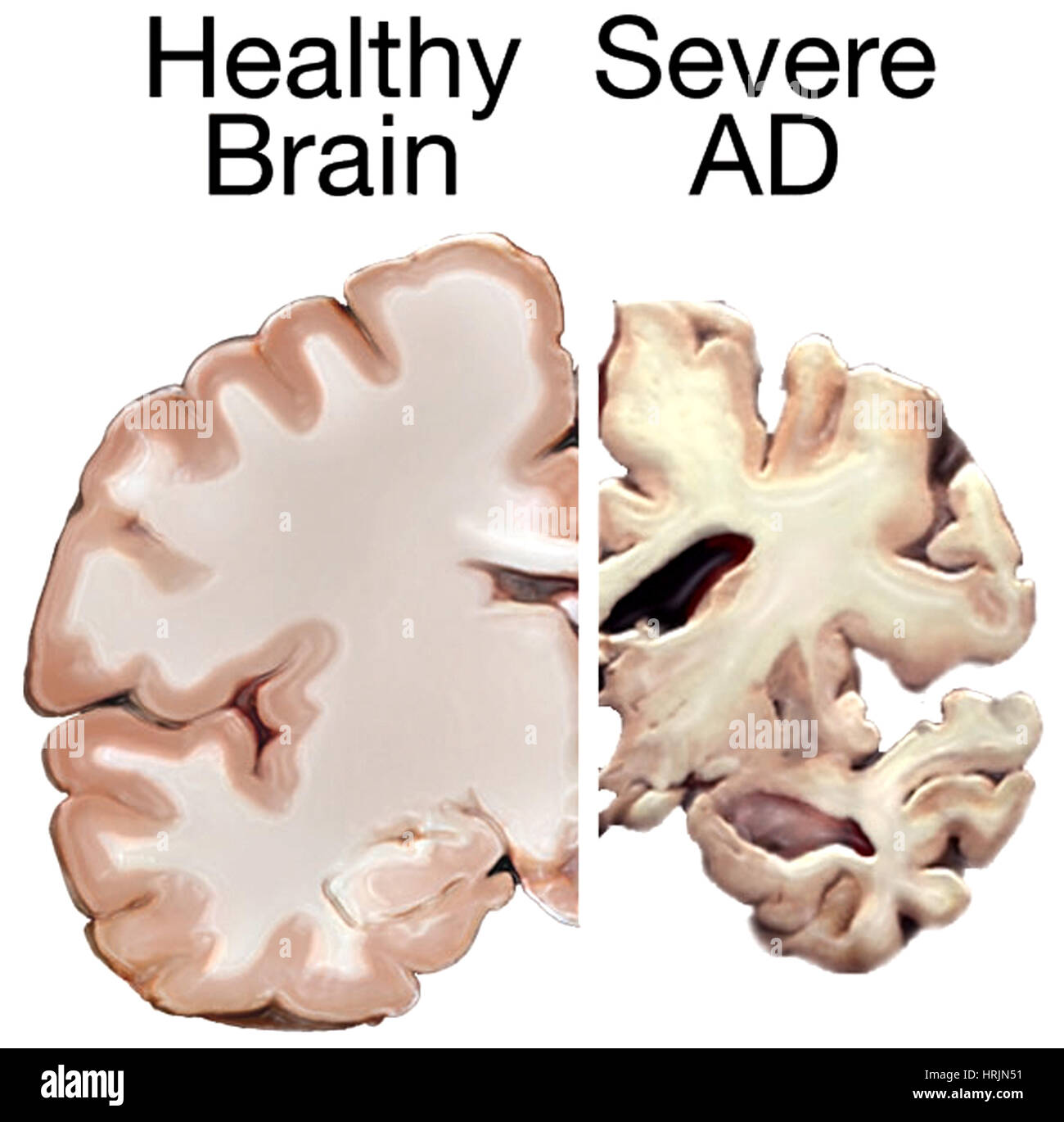Il morbo di Alzheimer, sani vs. gravi Foto Stock