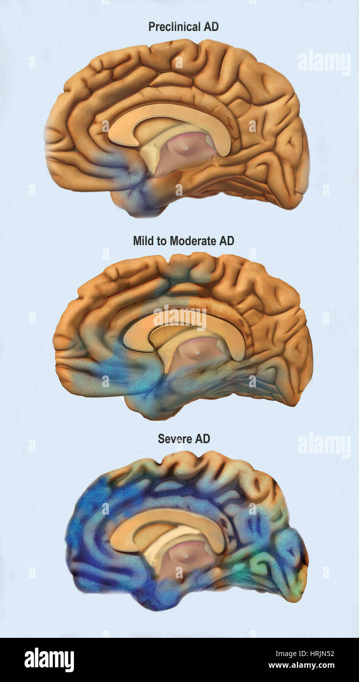 Il morbo di Alzheimer, gravità confronto Foto Stock