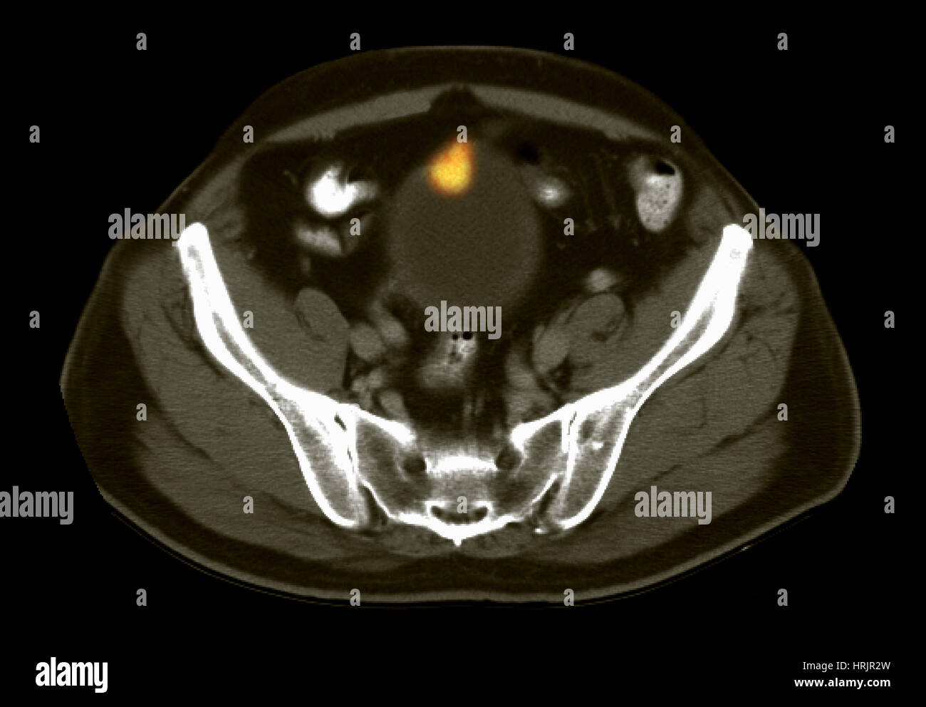 Il cancro della vescica, la scansione TC Foto Stock