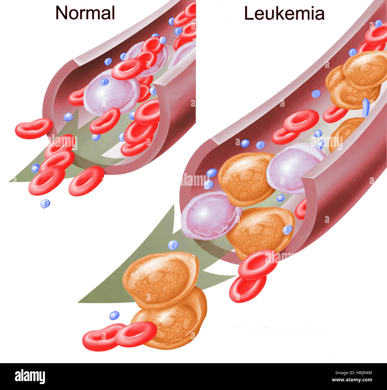 Cellule ematiche normali e leucemia Foto Stock